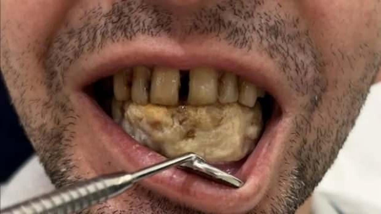 Diş kliniğine giden adam, doktoru şoka uğrattı: 'Hastamızın yeni icadı'