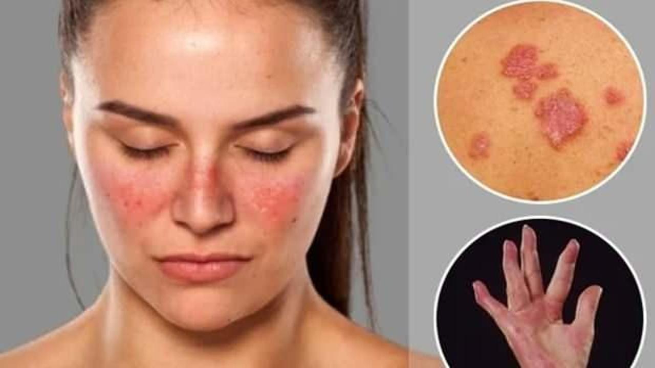 Lupus hastalığı ölümcül müdür, neden olur? Lupus hastalığı tedavisi nedir?
